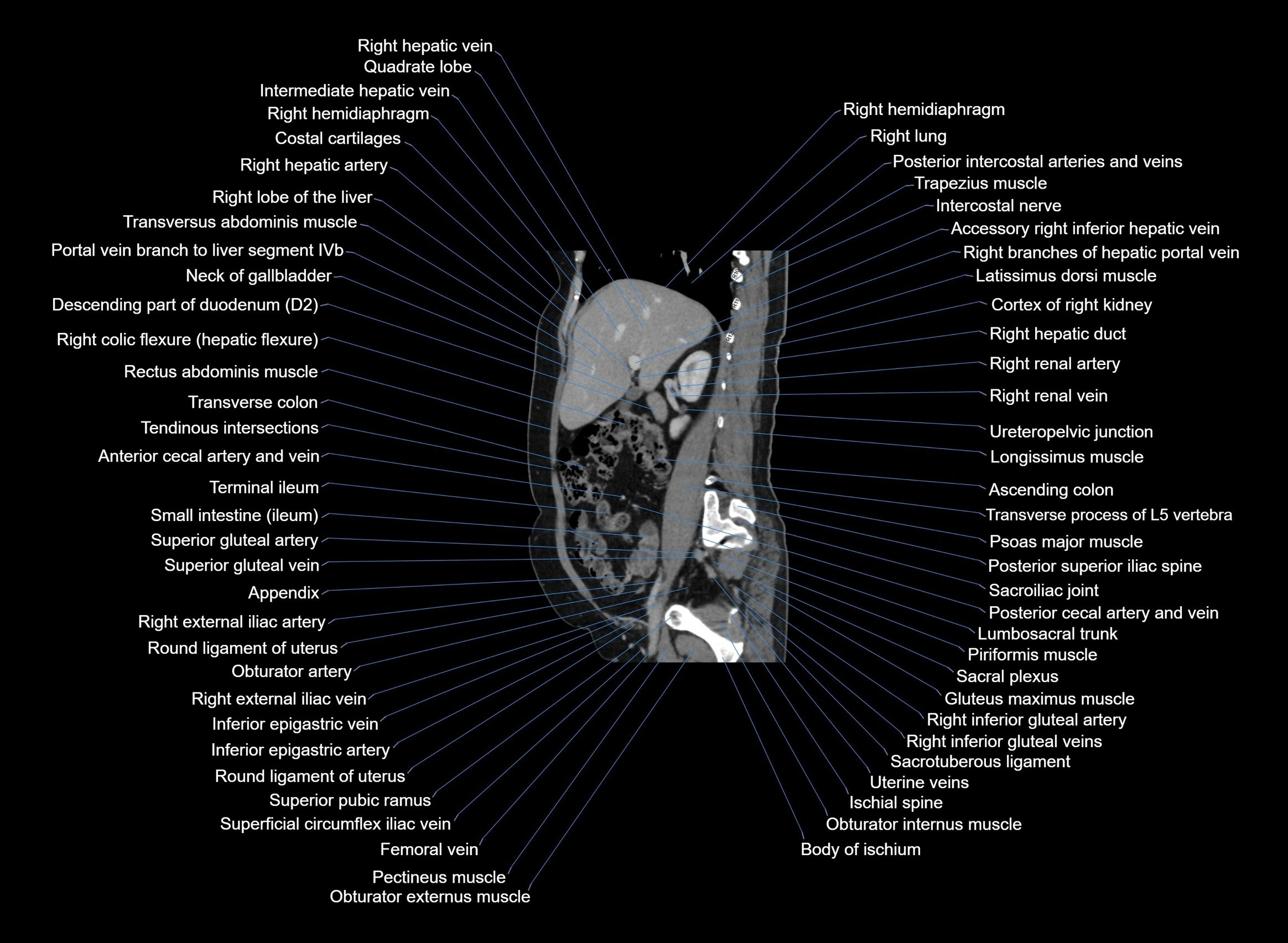 CT Abdomen sagittal cross sectional anatomy labelled radiology image -00075.webp